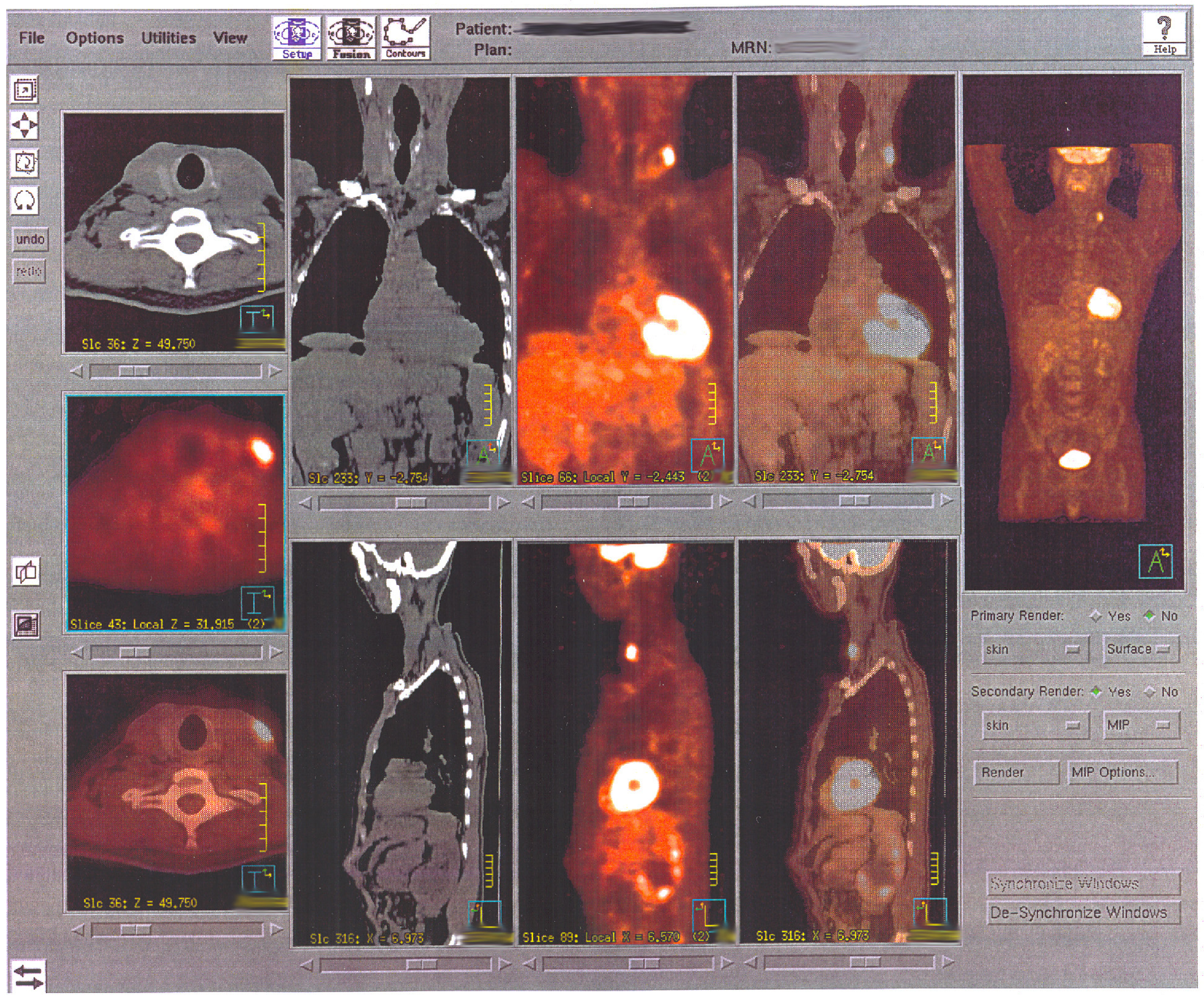 This figure shows multiple images from a PET scan.