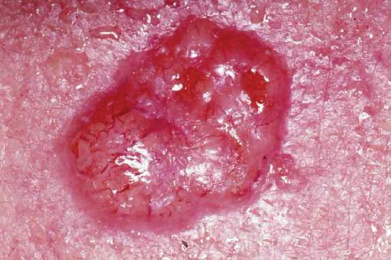 This photo shows an enlarged view of a basal cell carcinoma, a large, pink, irregular bump on the skin. The carcinoma is marked with irregular, dark-red stripes that resemble tiny blood vessels. The surrounding skin is the same pink color as the carcinoma, but without the red striping or raised appearance