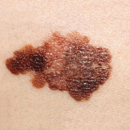 This photo shows a patch of fair skin containing a large melanoma. The melanoma is black and splotchy in appearance.