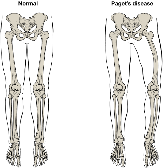 This illustration shows the normal skeletal structure of the legs from an anterior view. The flesh of the legs and feet are outlined around the skeleton for reference. A second illustration shows the legs of someone with Paget’s disease. The affected person’s left femur is curved outward, causing the left leg to be bowed and shorter than the right leg.