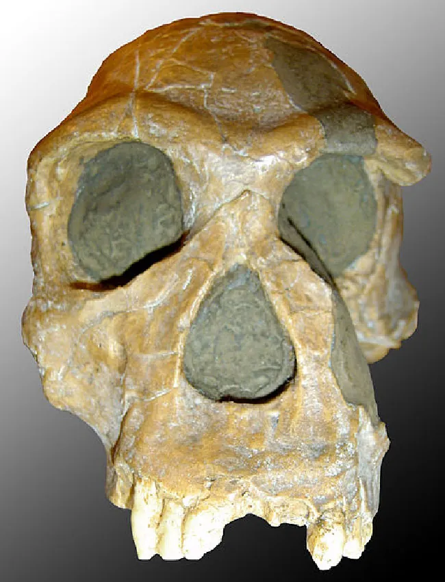 A picture of a skull is shown on a white to black ombre background. The bones are brown/gray in color. The top of the skull is round and cracked in places with a piece of bone missing on the right side. Large brow ridges, eye and nose holes, and the upper jaw are shown. Three teeth are shown on the left and two teeth are shown on the right upper jaw with a gap in the middle. Part of the right cheekbone is missing. The holes and broken pieces are filled in with a gray substance.