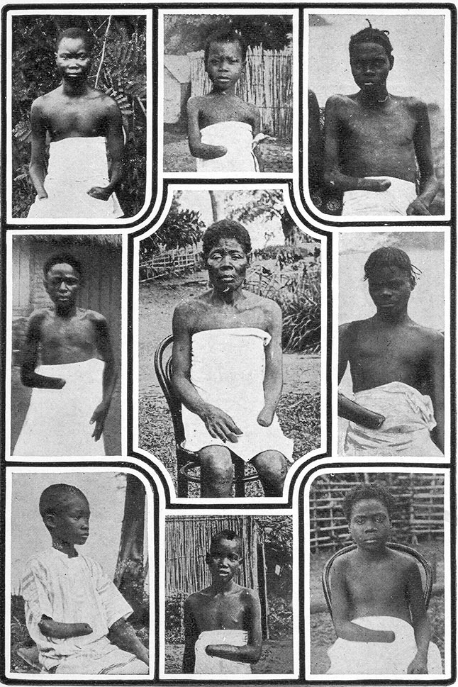 mutilated Congolese children