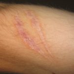 Scars on an arm