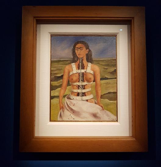 a nude woman with her spine showing wearing a brace to keep the fractures together